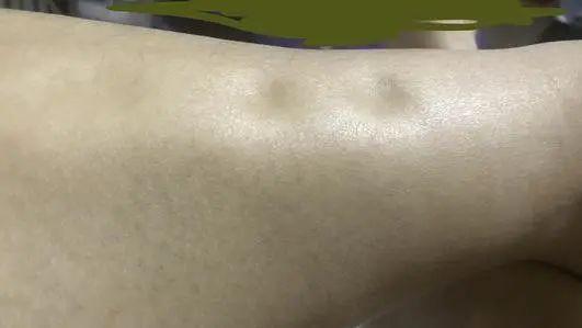 瘦小腿不同类型方法_判断肌肉腿脂肪腿水肿腿_瘦的人血脂高是什么原因