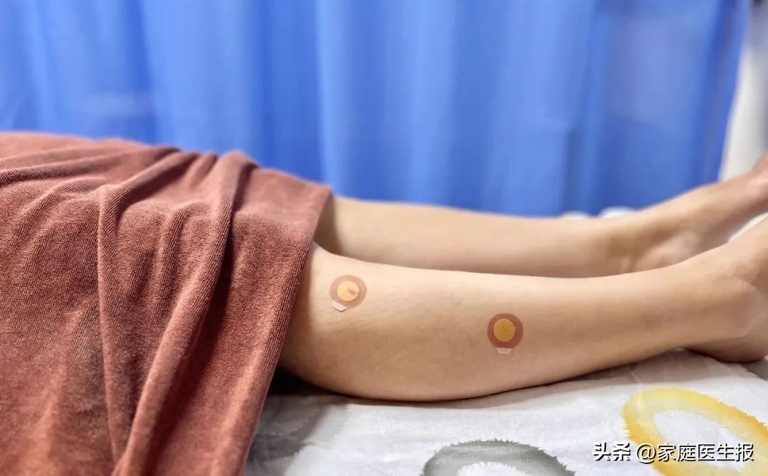 局部减肥有用吗_痰湿型肥胖埋线减肥_腹部埋线减肥优势