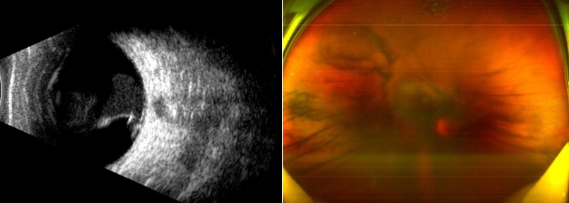 黄斑裂孔激光治疗_医美激光眼睛损伤_孕妇可以用美容仪吗