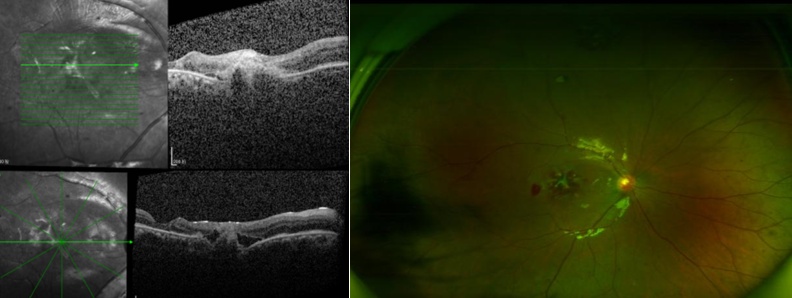 孕妇可以用美容仪吗_医美激光眼睛损伤_黄斑裂孔激光治疗