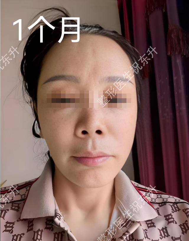 电波拉皮除皱做几次能除皱_退休金医美消费趋势分析_50+医美面部提升手术安全正规医院