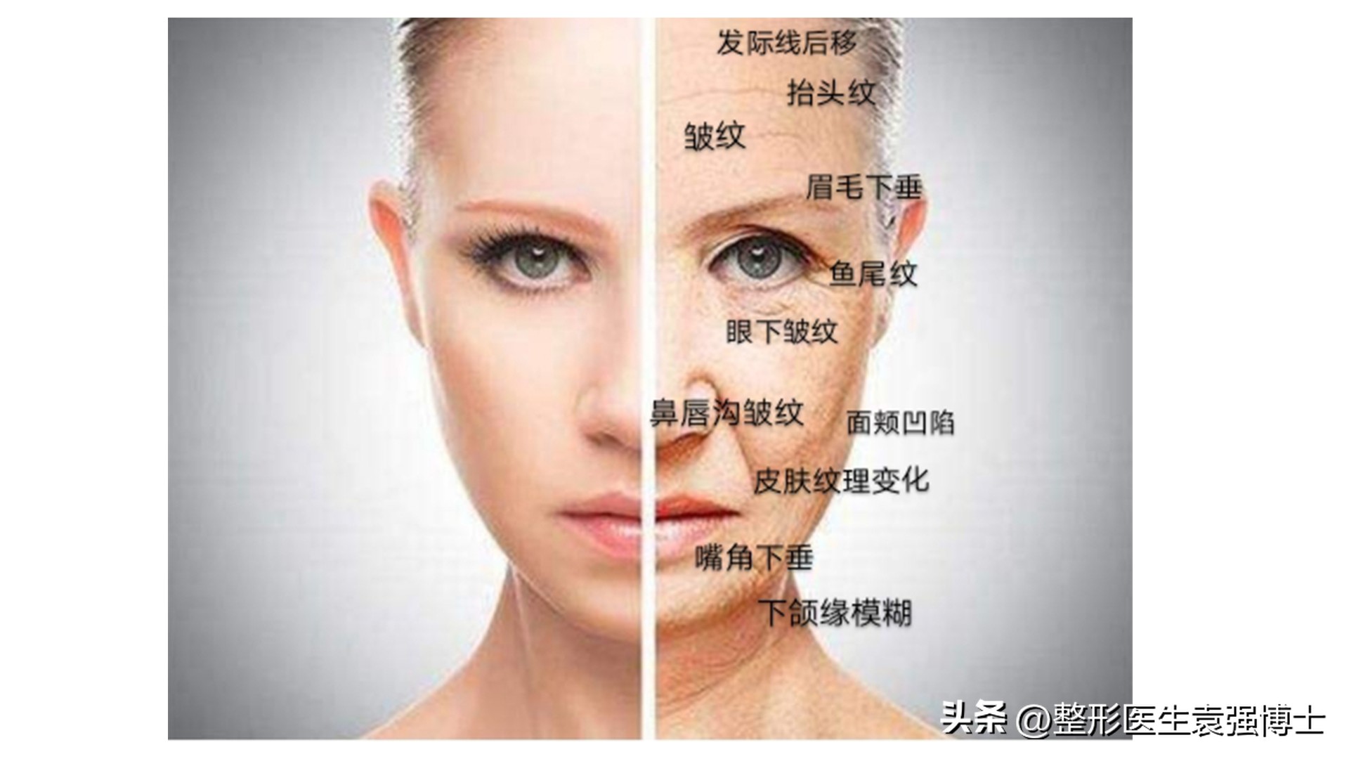 改善鱼尾纹_电波拉皮除皱做几次能除皱_改善抬头纹