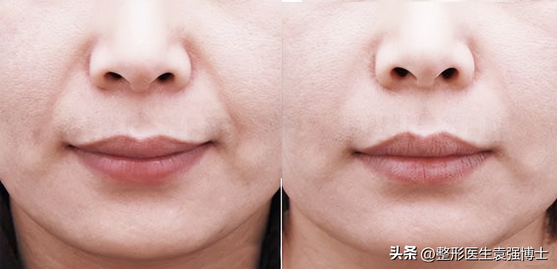 改善鱼尾纹_改善抬头纹_电波拉皮除皱做几次能除皱