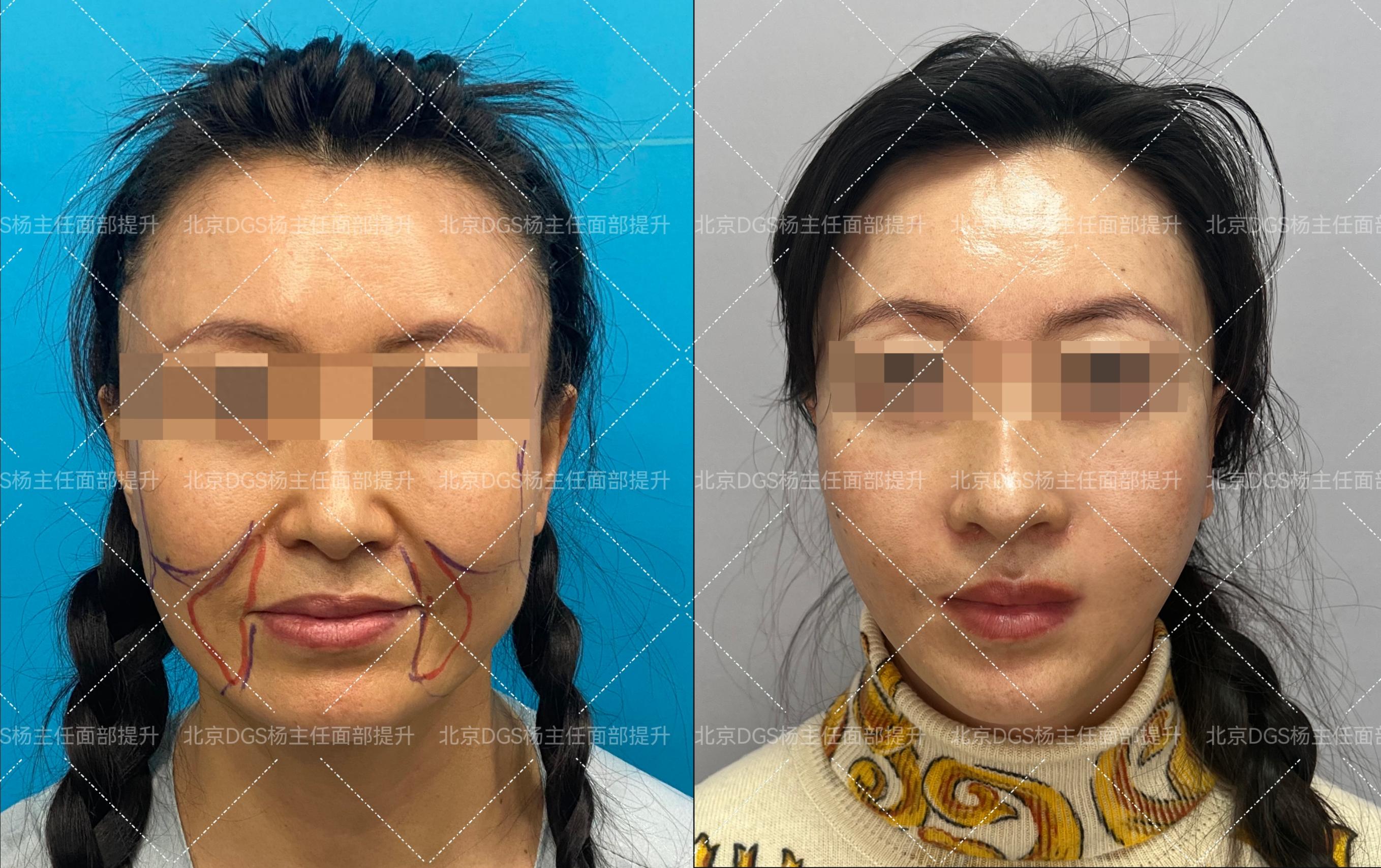 北京面部提升医院_电波拉皮除皱做几次能除皱_面部提升手术