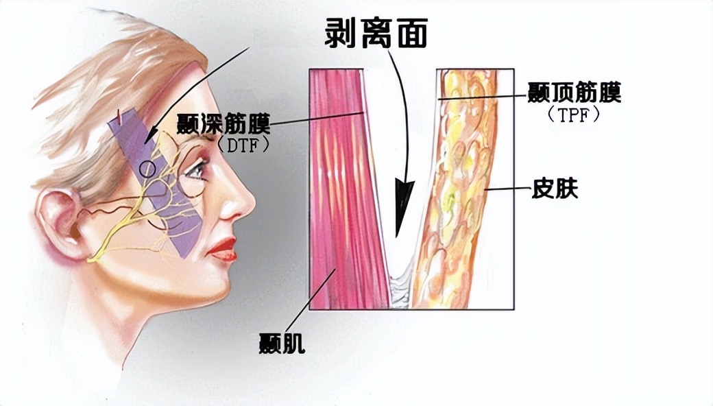 小拉皮术适合多大年龄_小拉皮手术是什么_电波拉皮除皱做几次能除皱