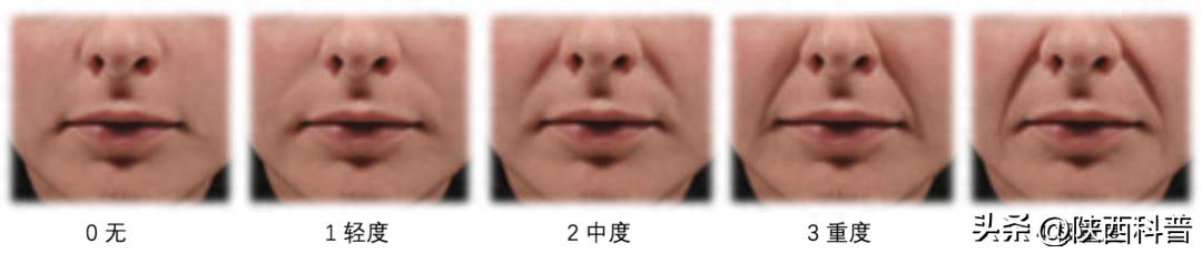 法令纹形成原因_如何去除法令纹_电波拉皮除皱做几次能除皱