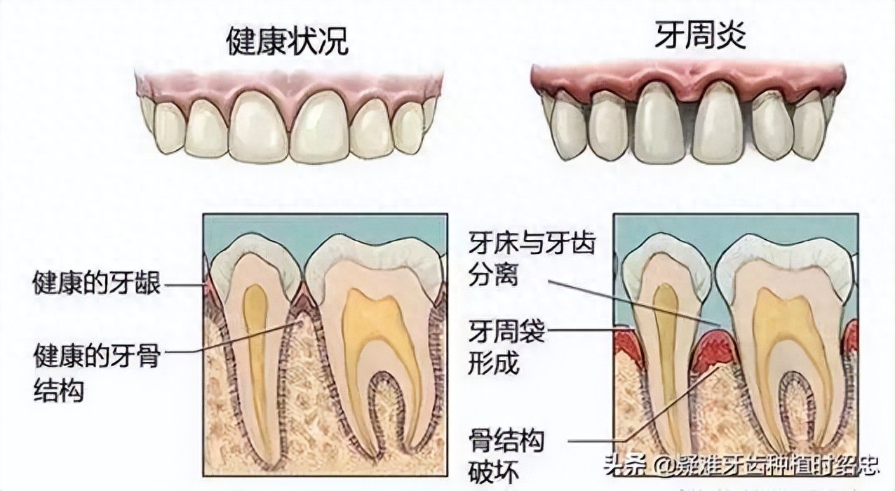 新澳门天天免费谜语下载 牙龈炎科普指南：从科学应对到长期守护，逆转口腔炎症
