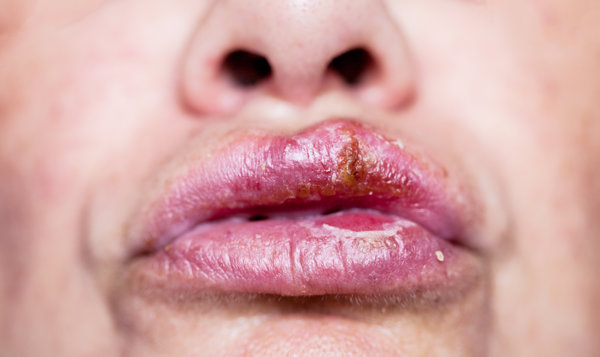 2025年天天免费资料,2025 嘴唇肿吃什么消肿最快