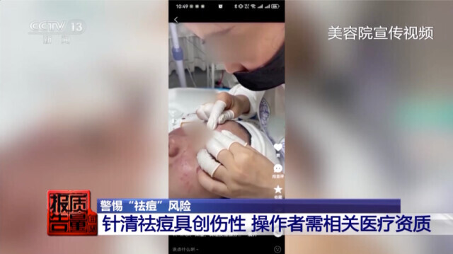 美容院祛痘_美容院做脸部护理好吗_针清祛痘危害