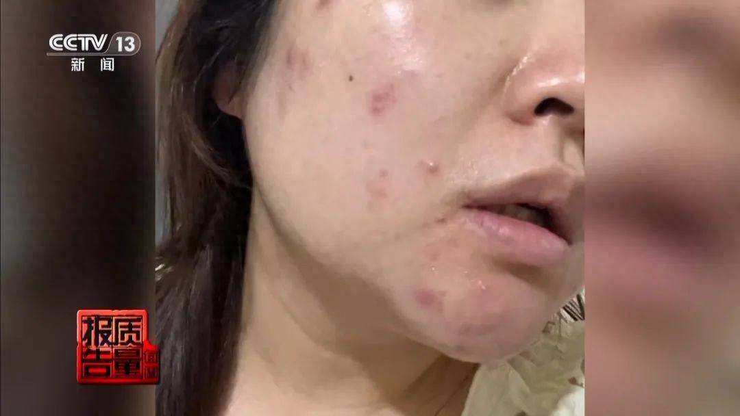 问鼎app官网下载安装 女子美容院祛痘，竟越祛越多！医生紧急提醒→