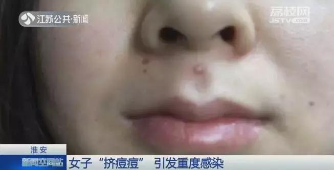 痘痘里的血要挤干净吗_危险三角区挤痘后果_脸上痘痘感染