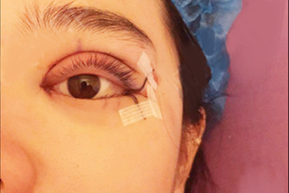 双眼皮贴使用危害_使用双眼皮纤维的坏处_眼皮松弛过敏反应